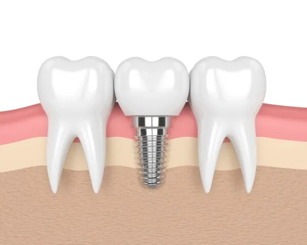 Différents types de prothèses dentaires